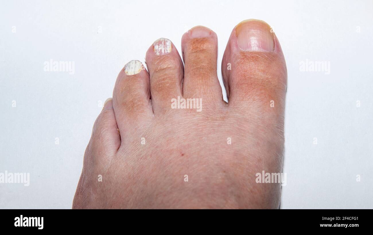 Linker Fuß mit Nagelpilz auf zwei Zehen Stockfoto