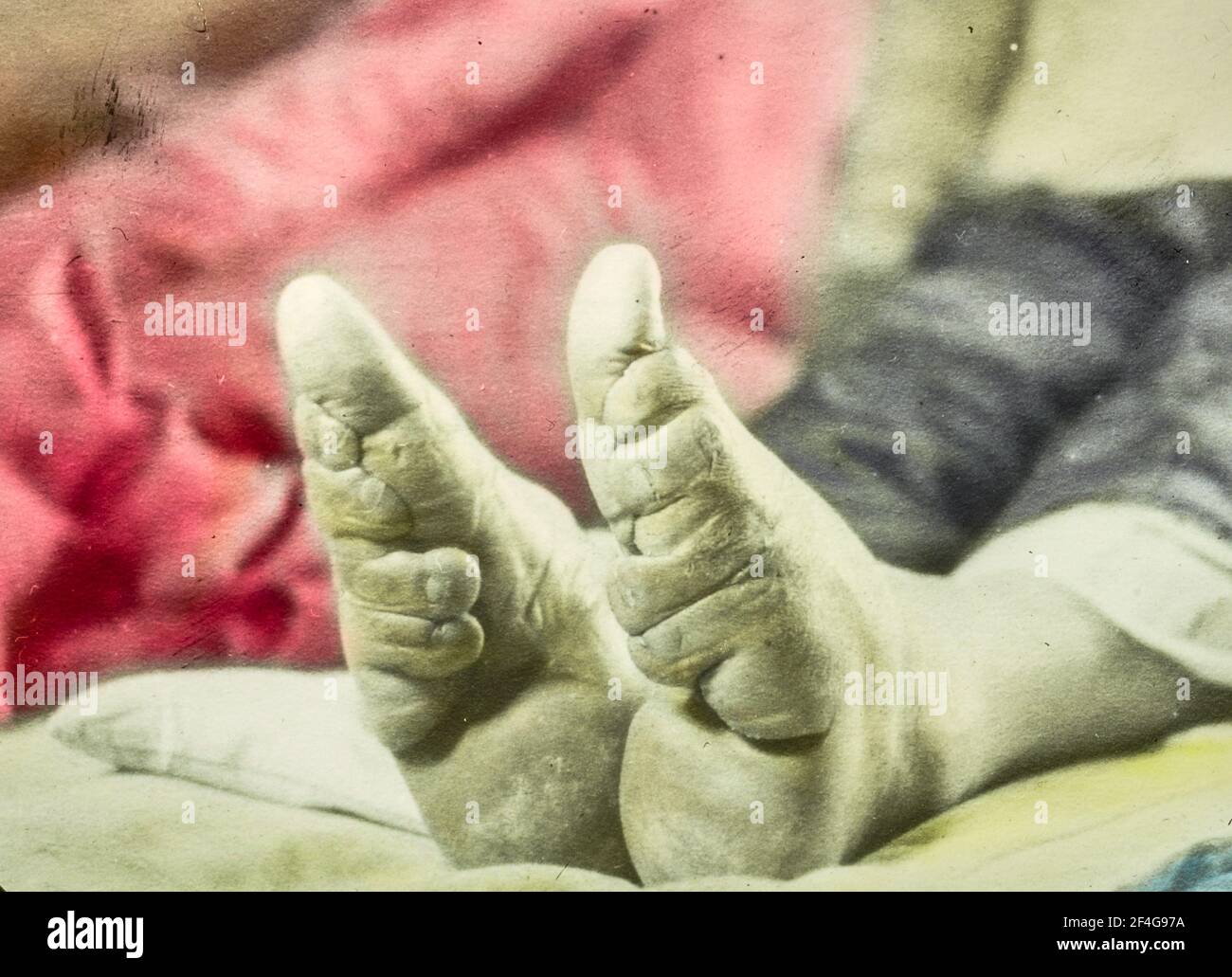 Nahaufnahmen der Füße eines weiblichen Kindes, die die Deformationswirkung der Fußbindung zeigen, die die Form und Größe der Füße einer Person veränderte und 1911, China, 1918, verboten wurde. Aus der Sammlung Sidney D. Gamble Photographs. () Stockfoto