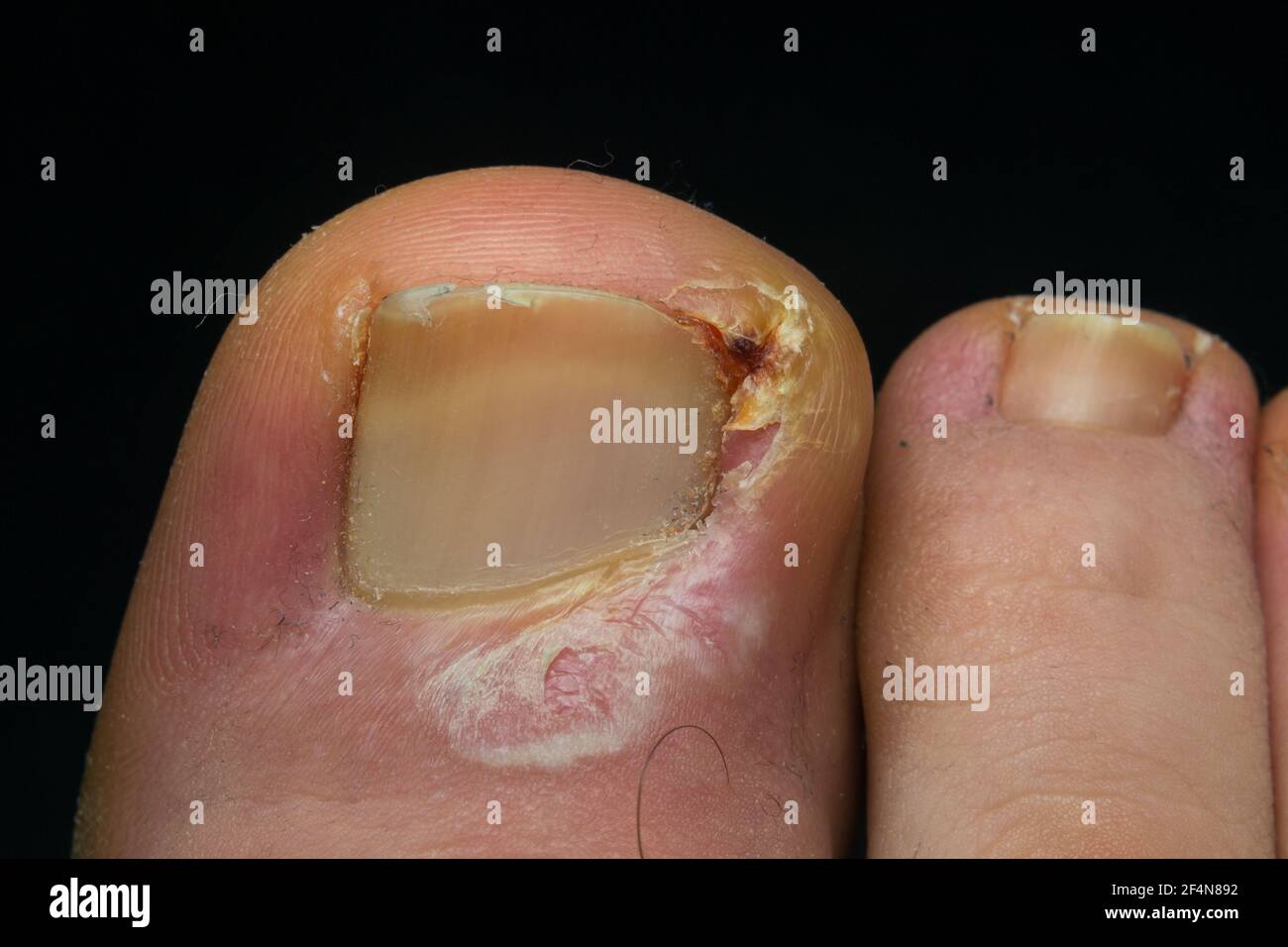 Nahaufnahme einer Zehennagelinfektion beim Menschen Stockfoto