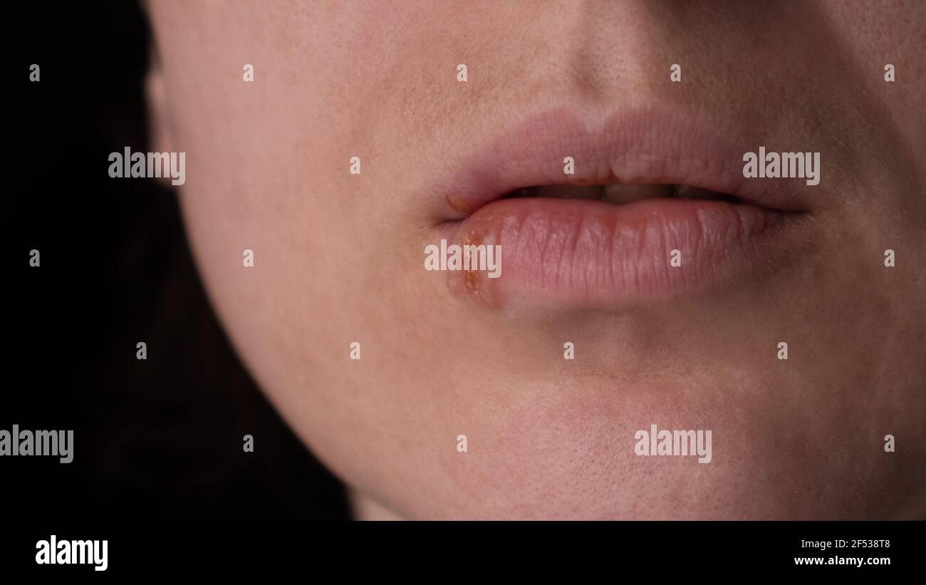 Herpes auf den Lippen, eine Frau mit einer Wunde auf der Lippe Nahaufnahme Stockfotografie Alamy