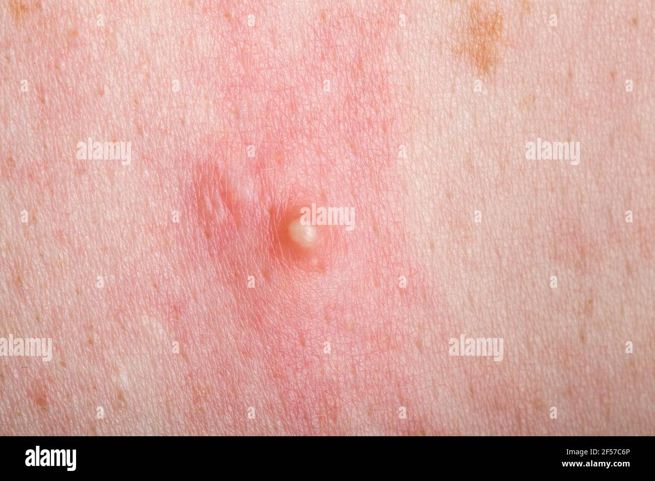 Der reife Pickel auf der entzündeten geröteten Haut des Menschen aus der  Nähe, Problem der trockenen Haut mit dem entzündlichen Ausschlag  Stockfotografie - Alamy
