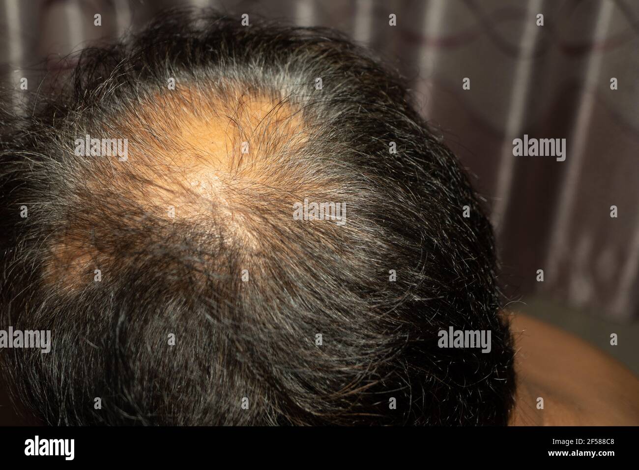 Kahlheit in Nahaufnahme. Alopecia Areata. Stockfoto