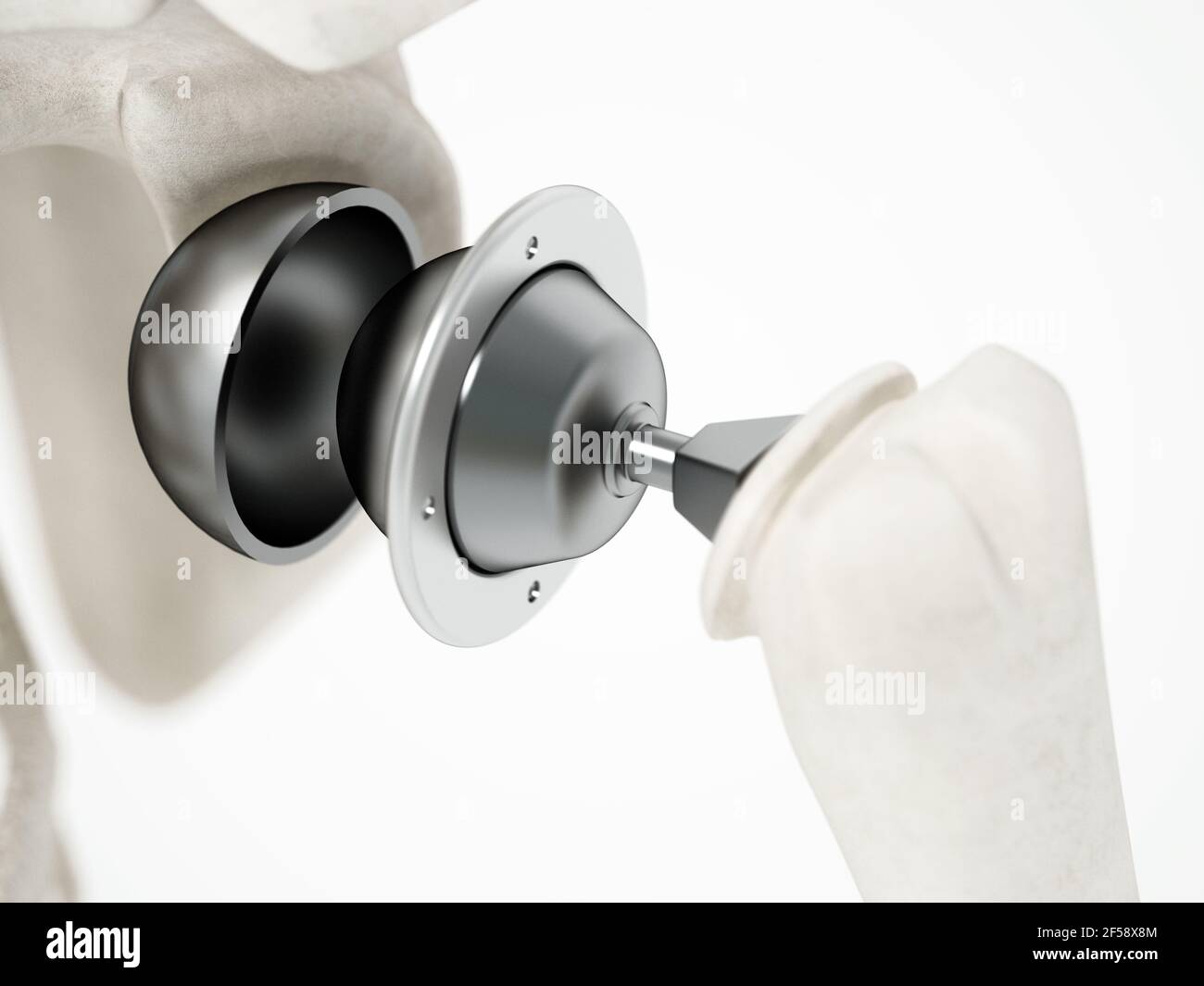 3D Abbildung der Schulterersatzoperation. 3D Abbildung. Stockfoto