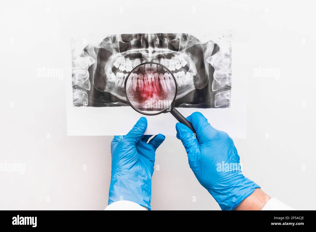 Ein Arzt in medizinischen Schutzhandschuhen hält ein Röntgenbild der Zähne in ihren Händen und untersucht es durch eine Lupe auf weißem Hintergrund. Stockfoto