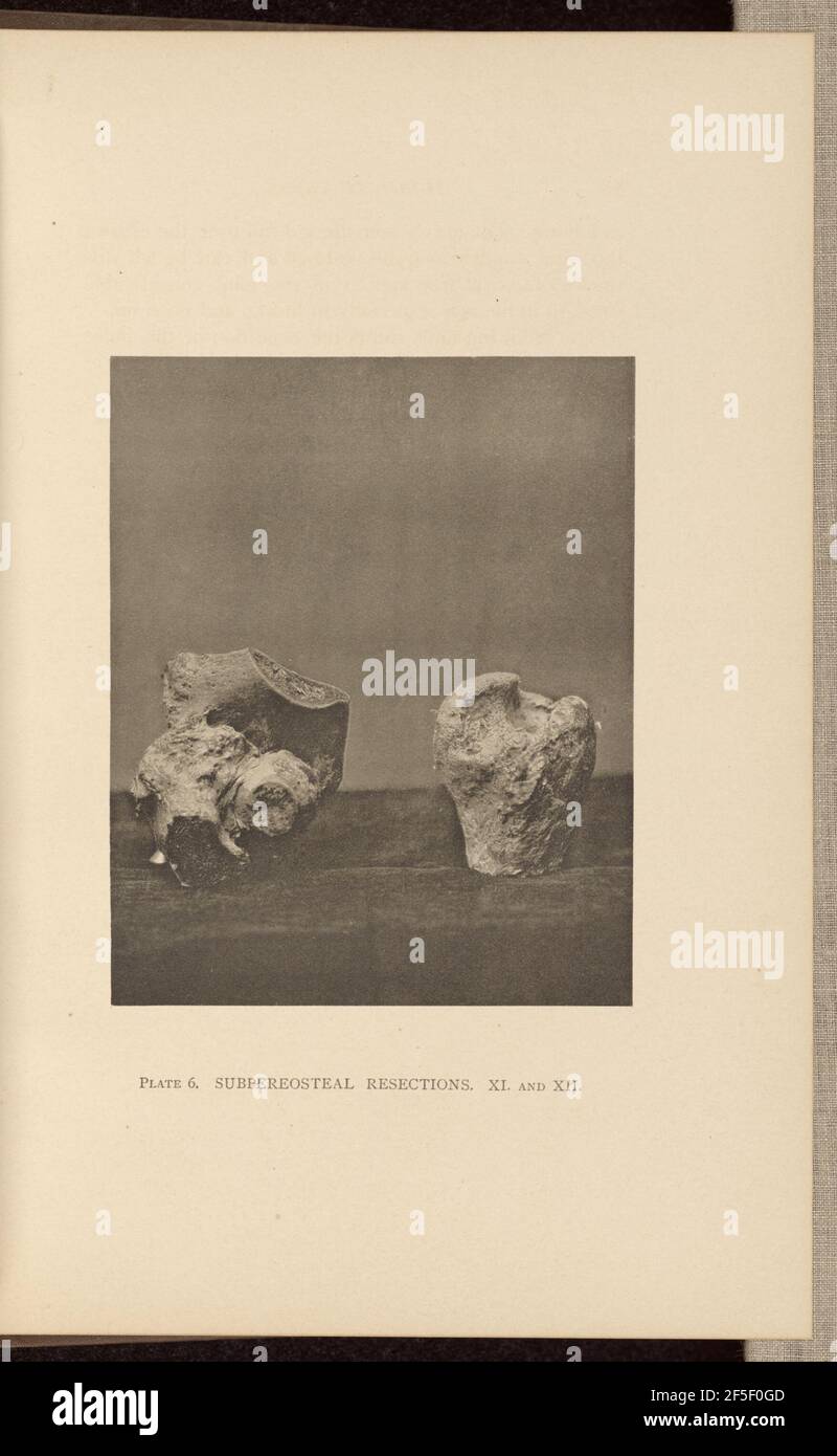 Subpereosteale Resektionen. Charles B. Brigham (amerikanisch, 1845 - 1903) Stockfoto