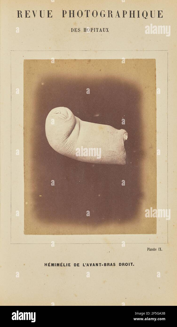 Hémimélie de l'avant-bras droit. Arthur de Montmeja (Französisch, geboren 1841) Stockfoto