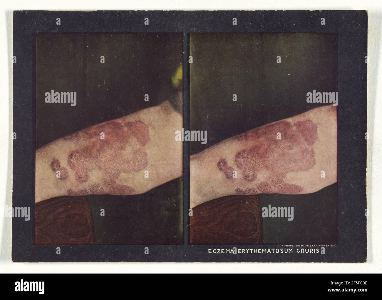 Ekzem Erythematosum Cruris. Dr. Selden I. Rainforth (amerikanisch, 1879 - 1960) Stockfoto