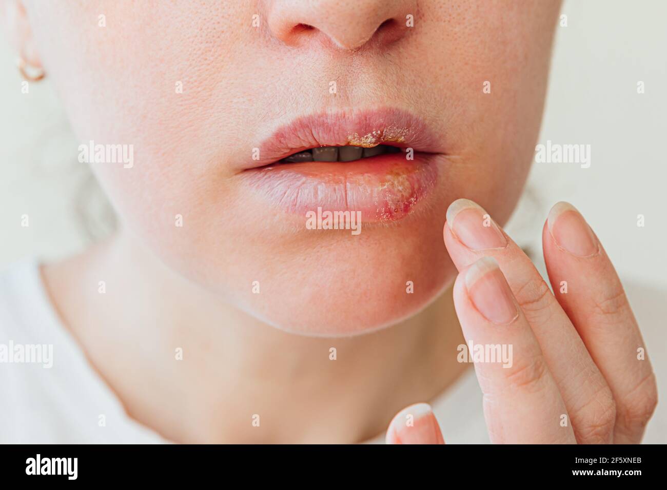 Nahaufnahme von Mädchen Lippen von Herpes betroffen. Behandlung von Herpes-Infektion und Virus. Teil der jungen Frau Gesicht mit Finger berühren Schmerzen auf den Lippen mit Stockfoto