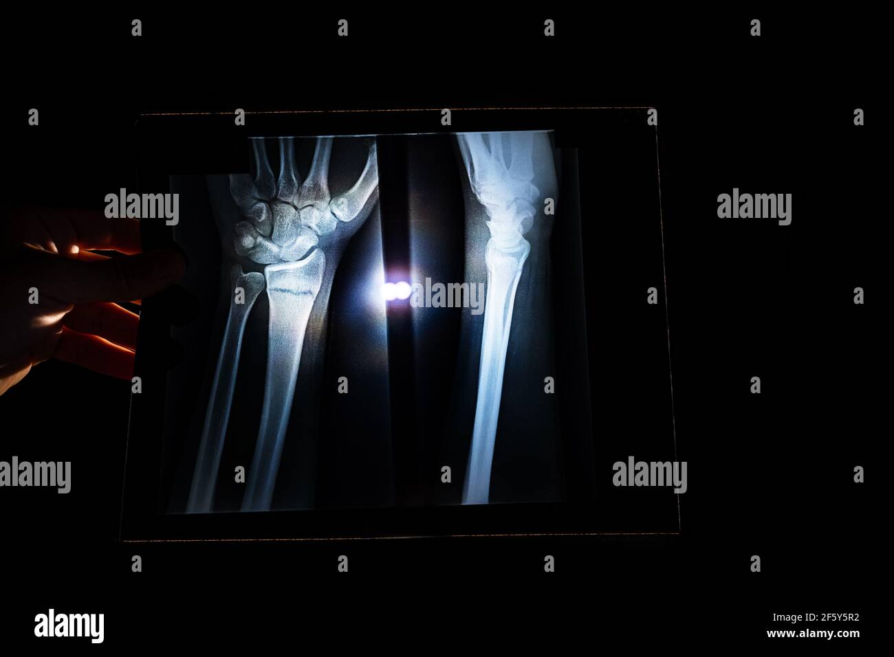 Person, die einen Röntgenstrahl von Armen und Hand im Dunkeln hält. Medizinisches Konzept Stockfoto