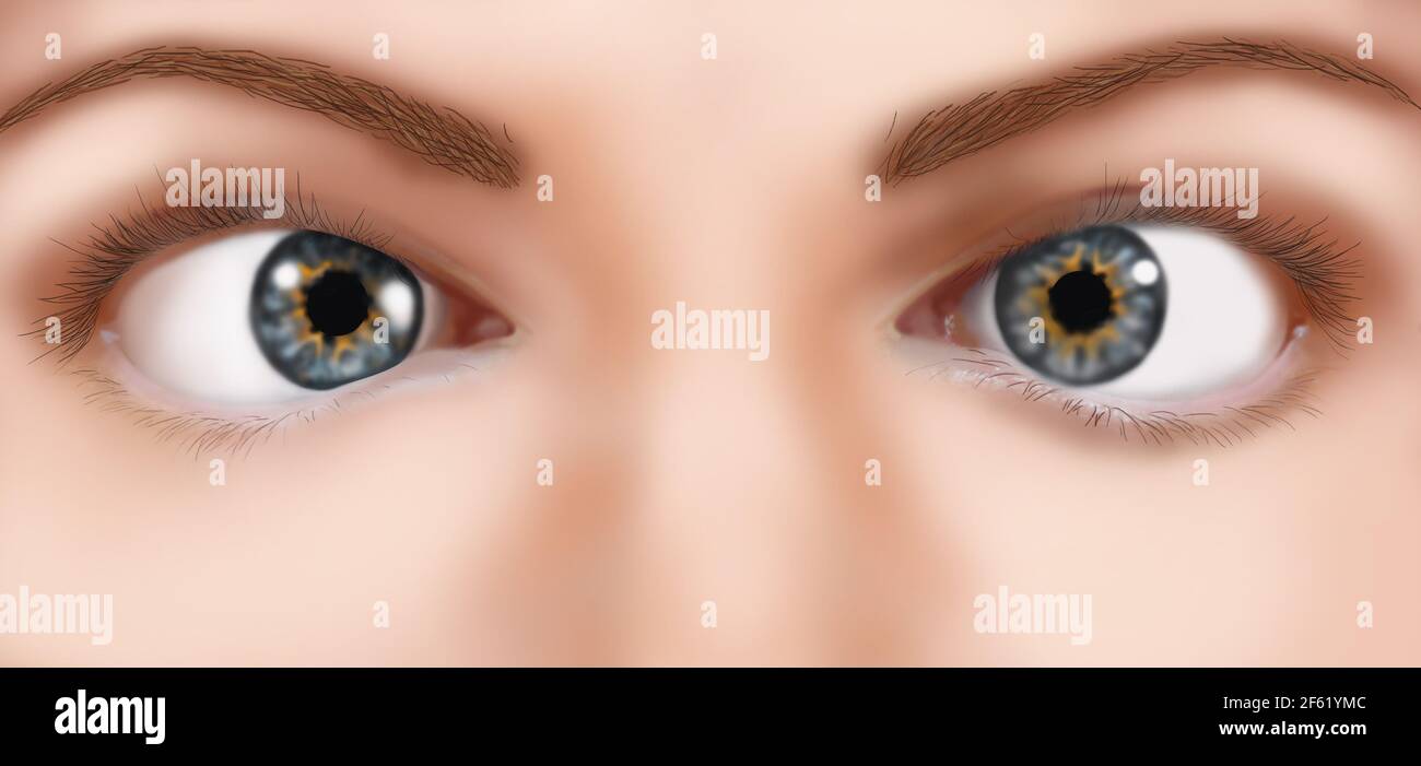 Strabmismus (Lazy Eye) Stockfoto