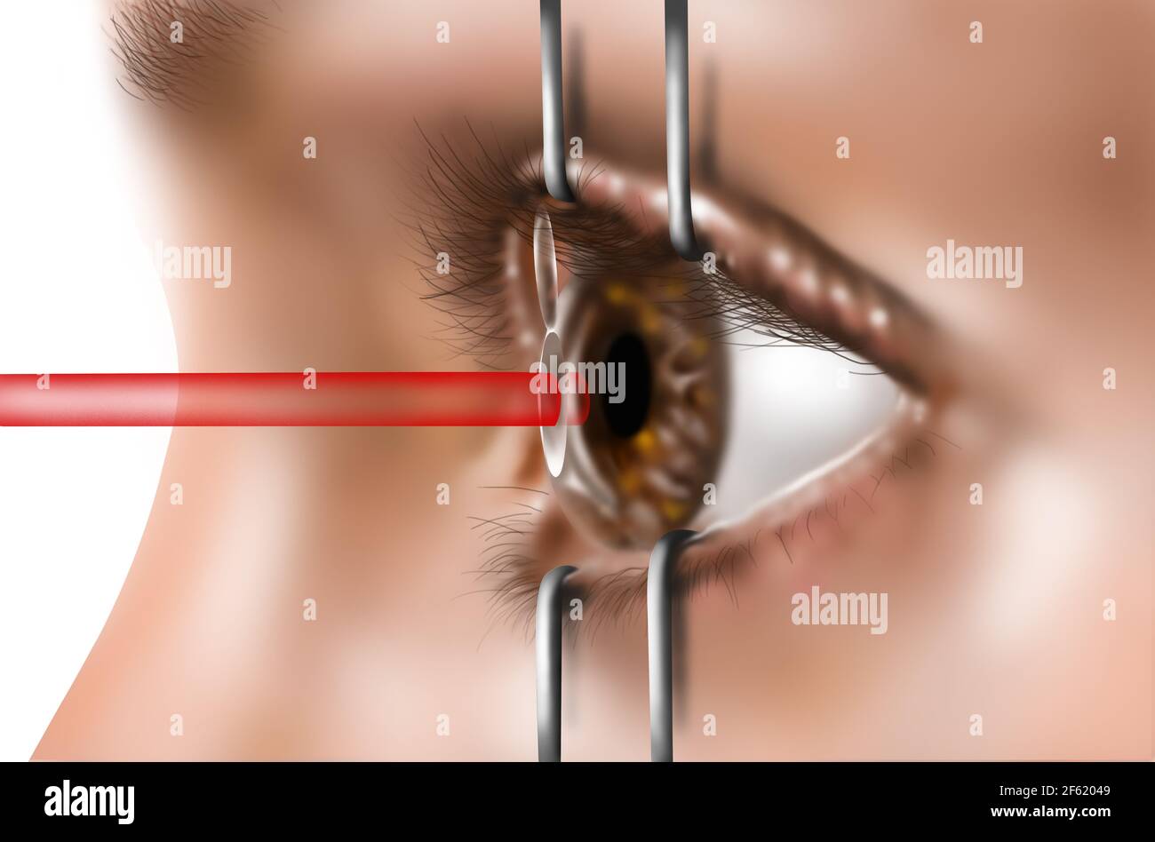 Laser-Augenchirurgie Stockfoto