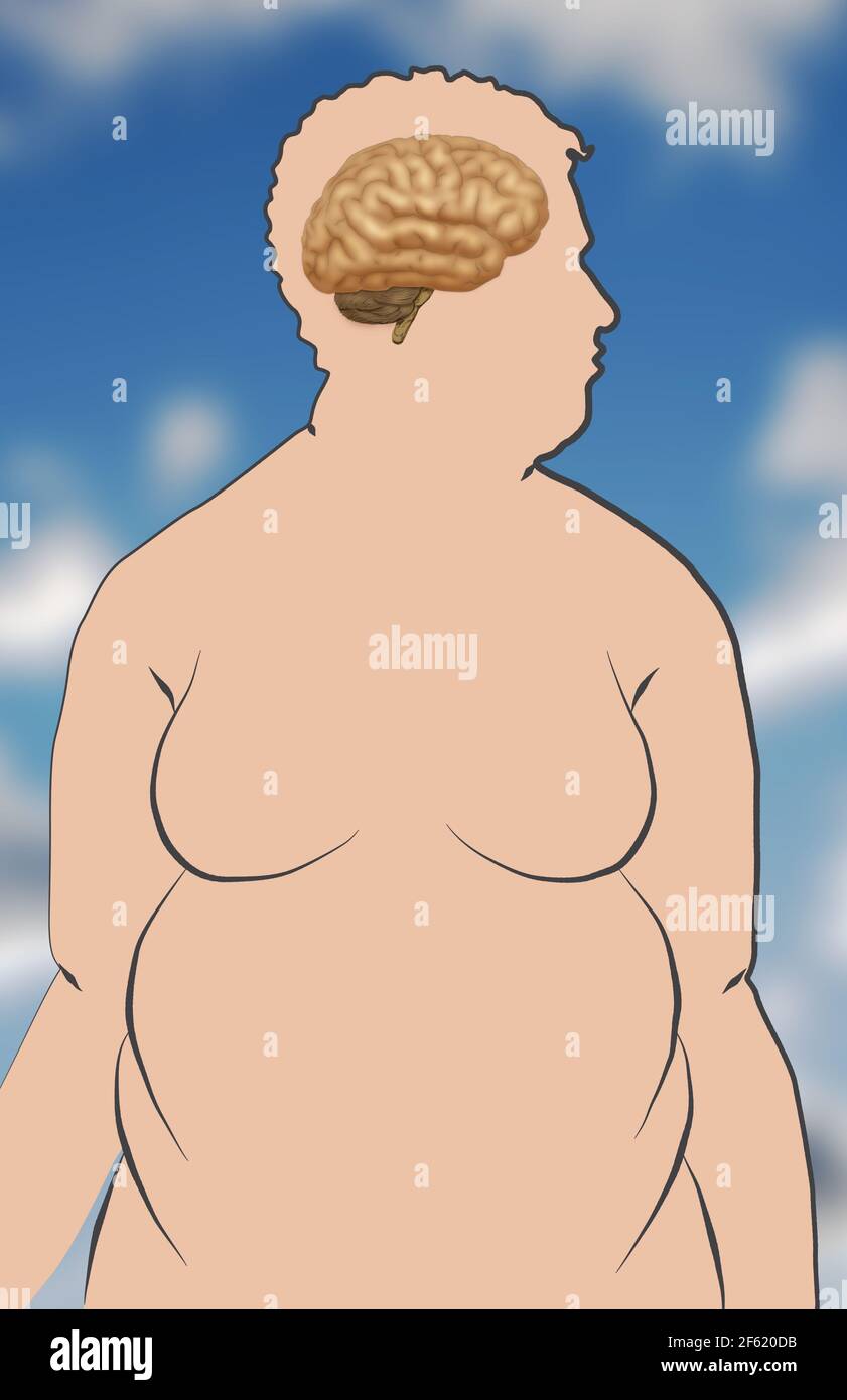 Adipositas erhöht das Risiko eines Schlaganfalls Stockfoto