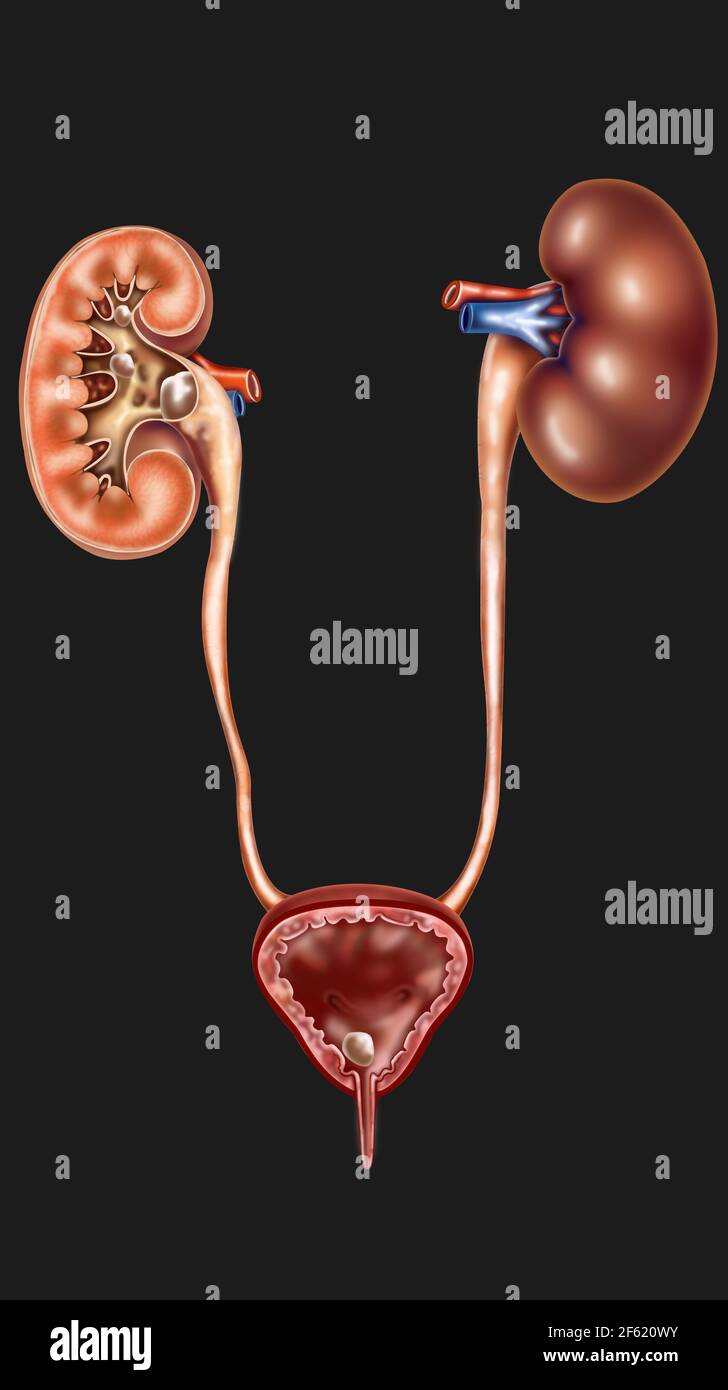 Nierensteine Stockfoto