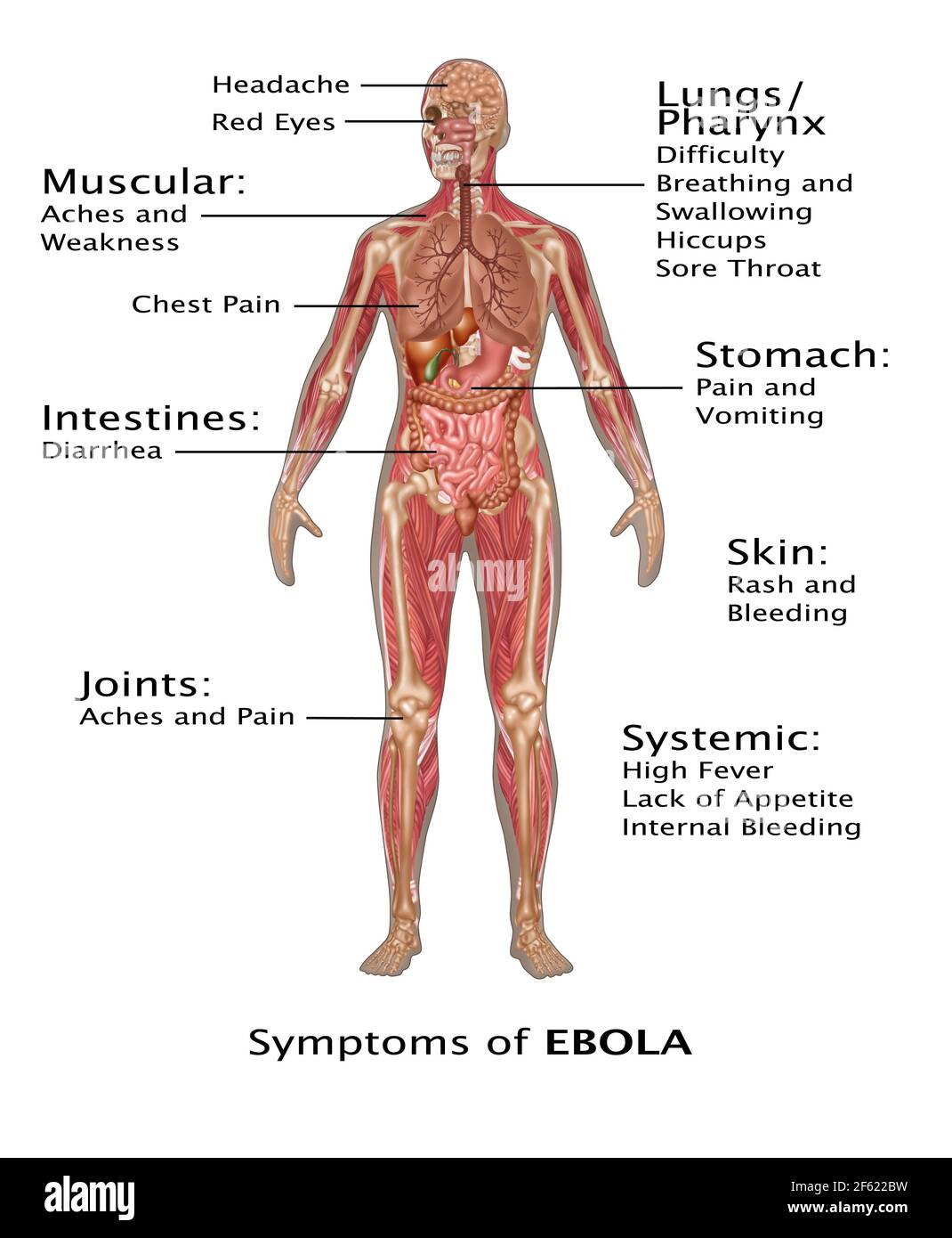 Ebola-Virus-Symptome beim Menschen, Illustration Stockfoto
