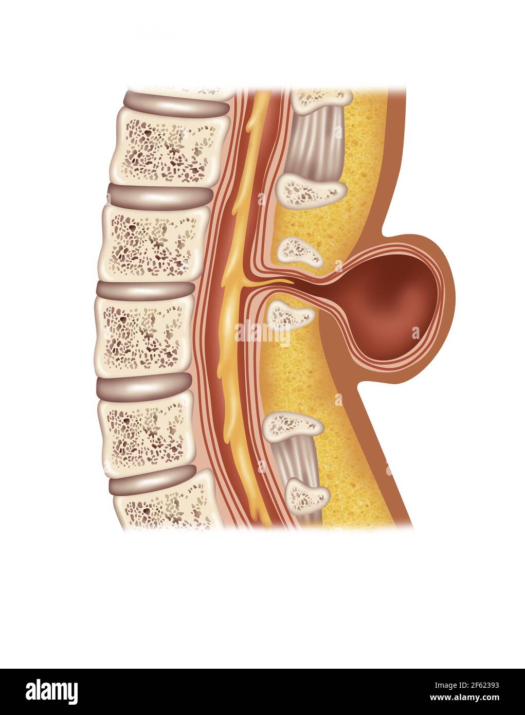 Spina Meningocele, Illustration Stockfoto