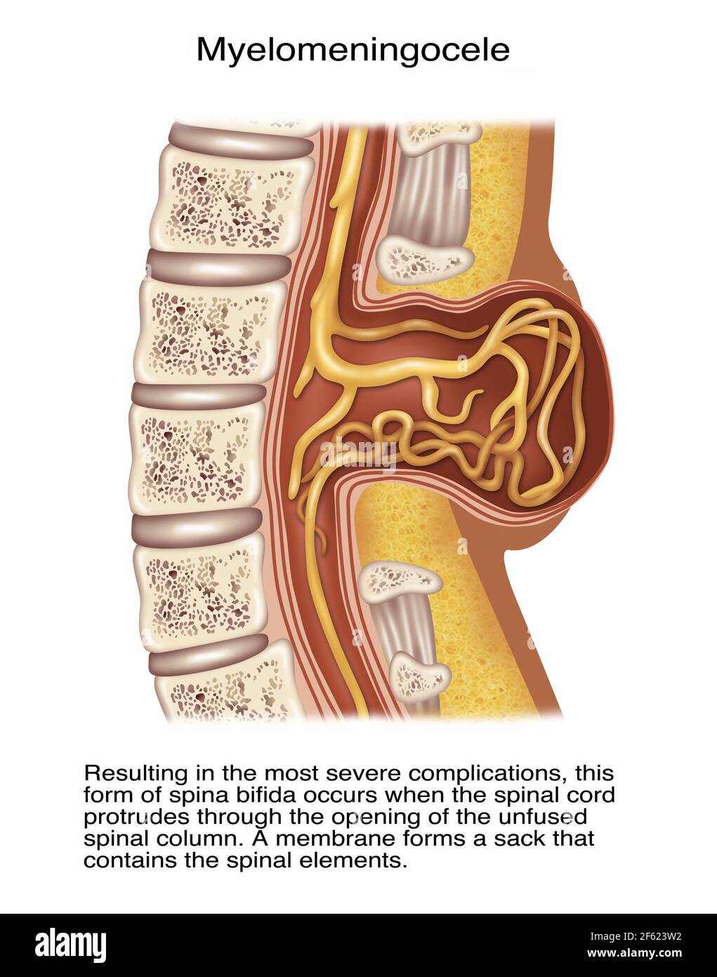 Spina Myelomeningocele, Illustration Stockfoto