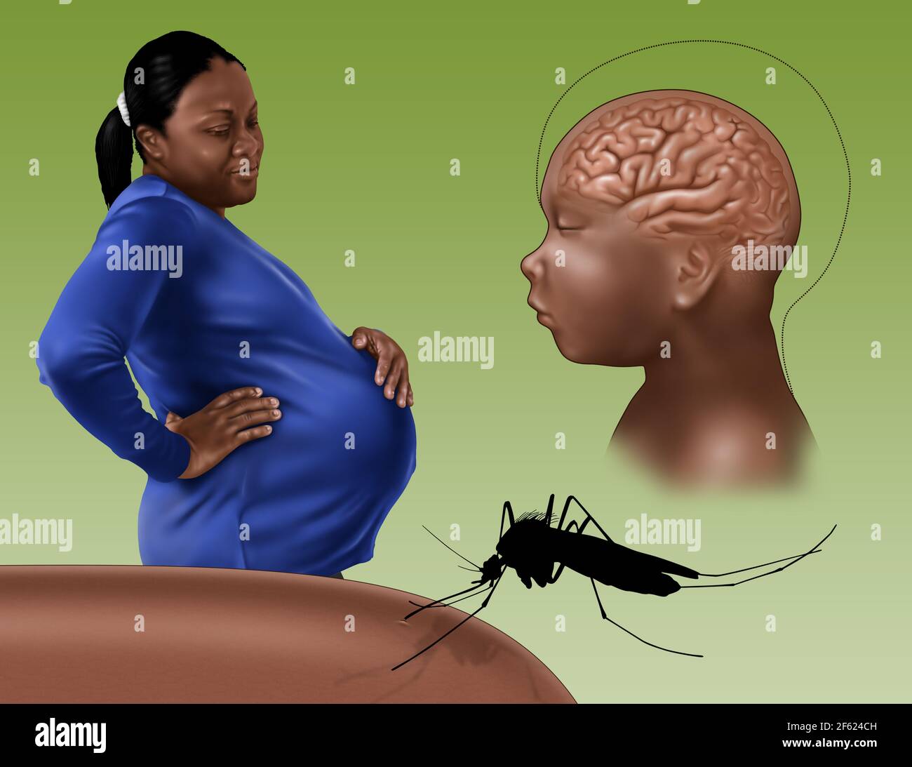 Mikrozephalie, Zika-Virus, Illustration Stockfoto