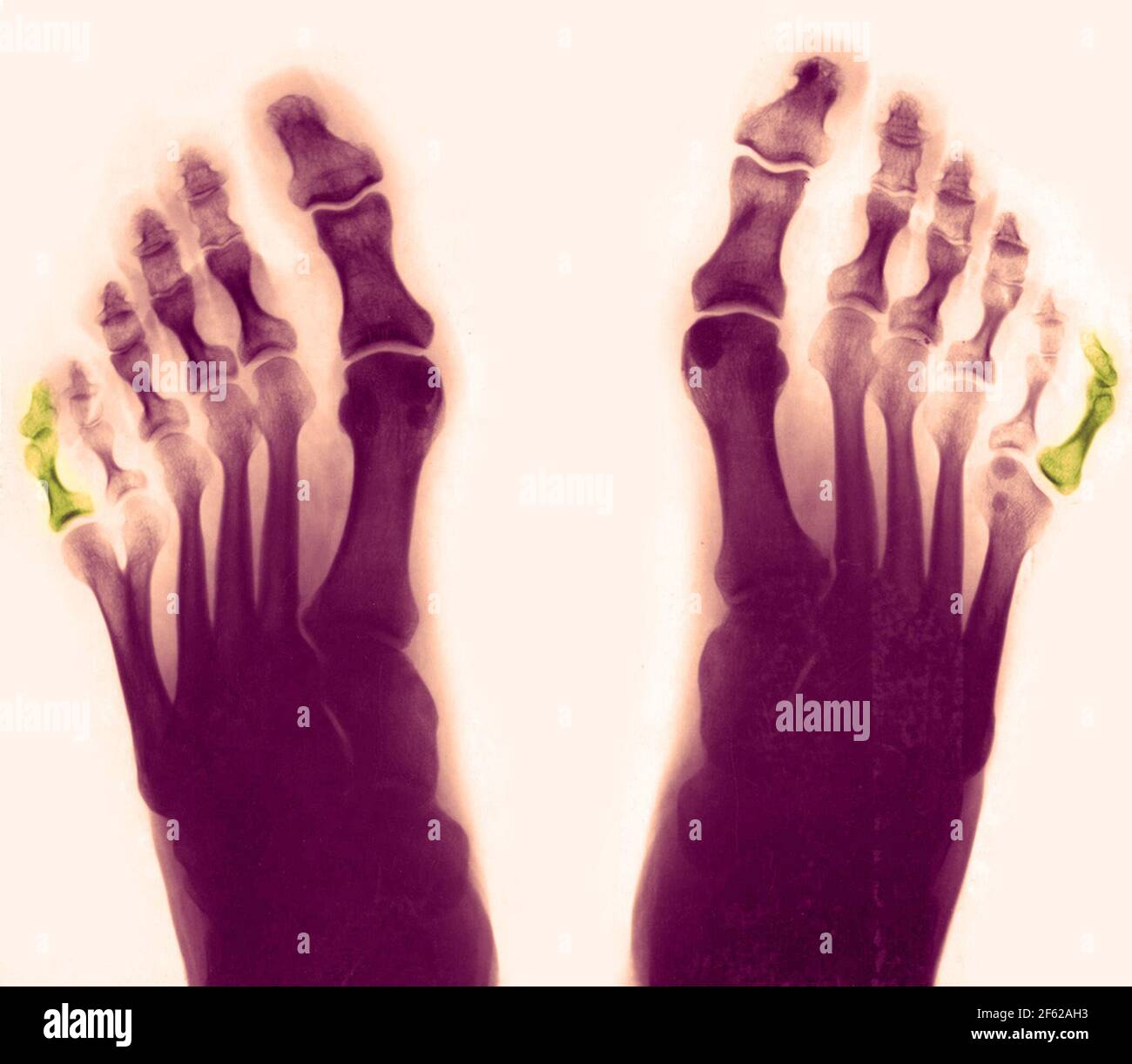 Polydaktyly, zusätzliche Zehen, Röntgen Stockfoto