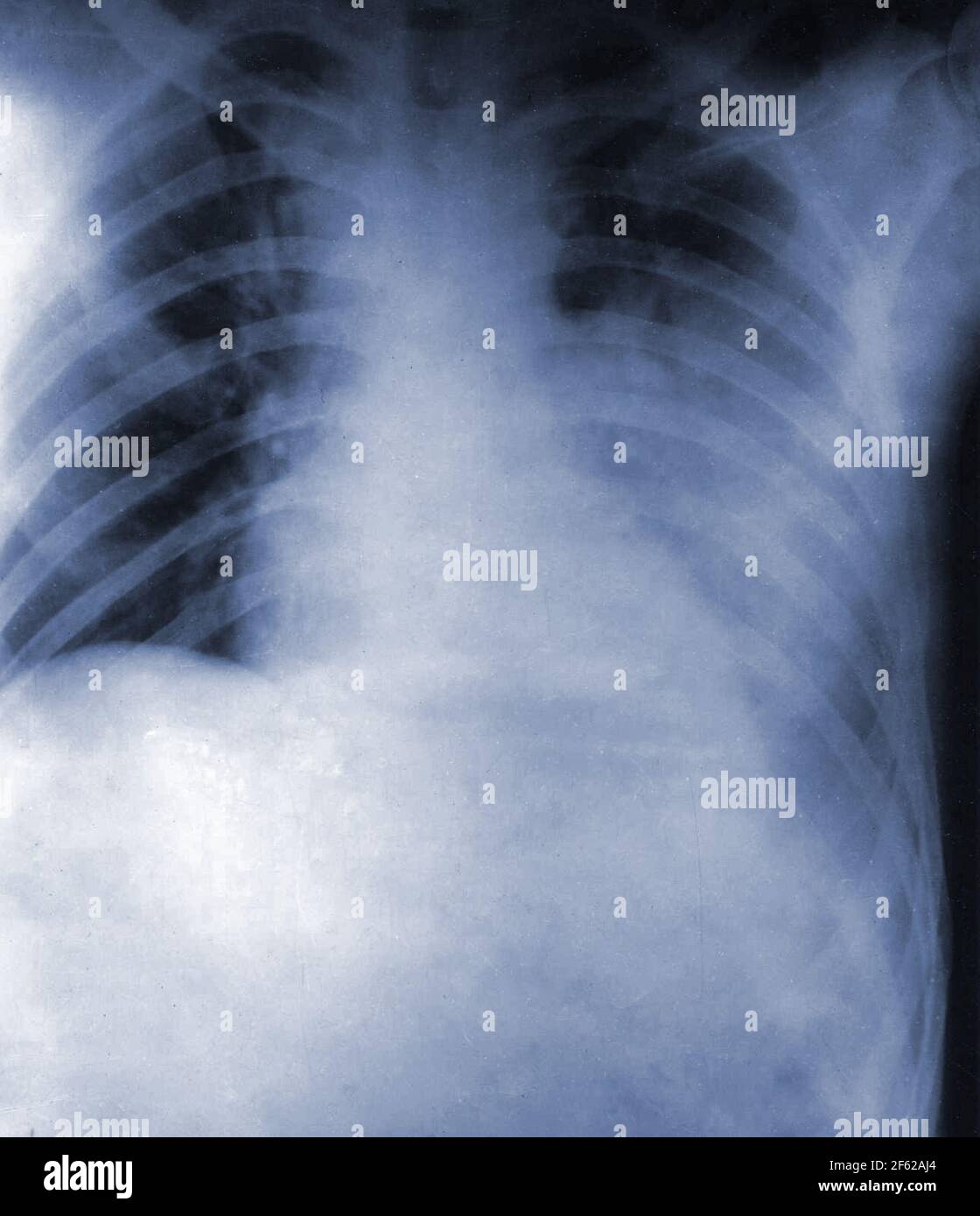 Spanische Grippe, Röntgenaufnahme der Brust, 1918 Stockfoto