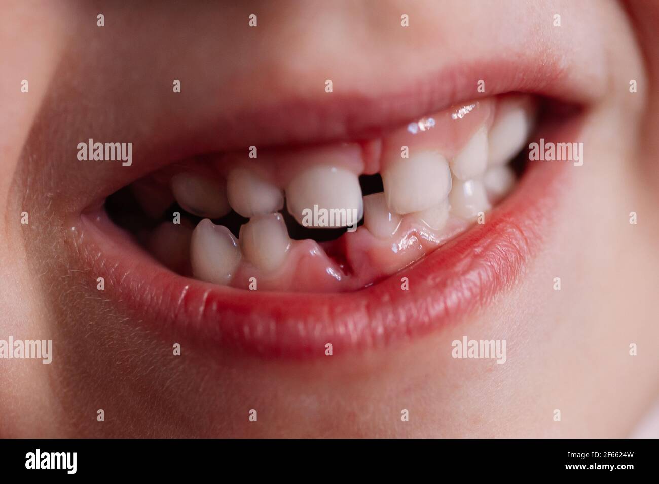 Nahaufnahme Makro der offene Mund des Kindes mit komprimierten Zeilen Von Zähnen und Anzugsloch im Zahnfleisch aus dem Der erste Babyzahn, der gerade herausgefallen ist Stockfoto