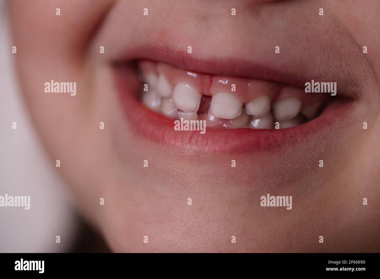 Nahaufnahme Mund eines fünfjährigen Kindes mit Babyzähnen, die obere Reihe von Zähnen hilft kippen nach vorne verlieren einen temporären Zahn Stockfoto