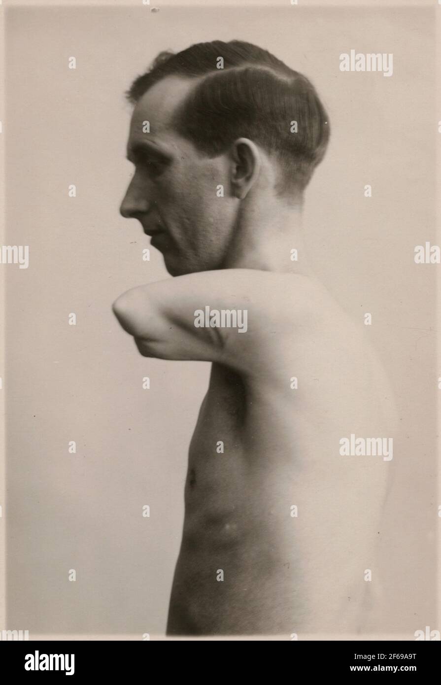 Fotografie aus "Beschreibung der Herstellung in der Zahnarztwerkstatt der Staatsbahn in Nässjö", 1932.Mann mit Amputearm, um eine Prothese aus der Prothesenwerkstatt in Nässjö zu erhalten. Stockfoto