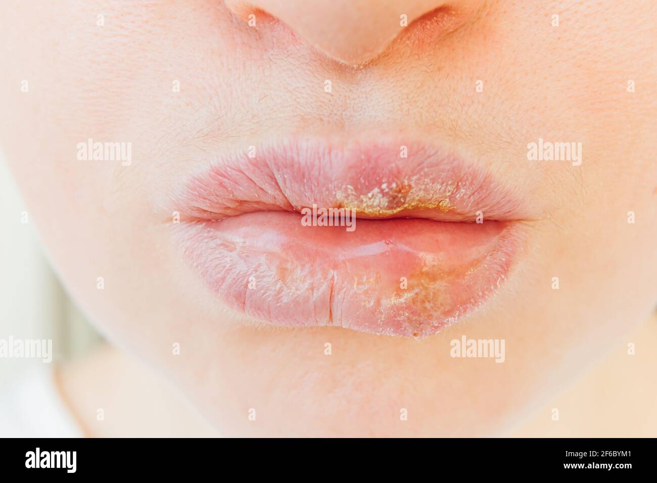 Nahaufnahme von Mädchen Lippen von Herpes betroffen. Behandlung von Herpes-Infektion und Virus. Teil der jungen Frau Gesicht, Lippen mit Herpes betroffen. Schönheit Stockfoto