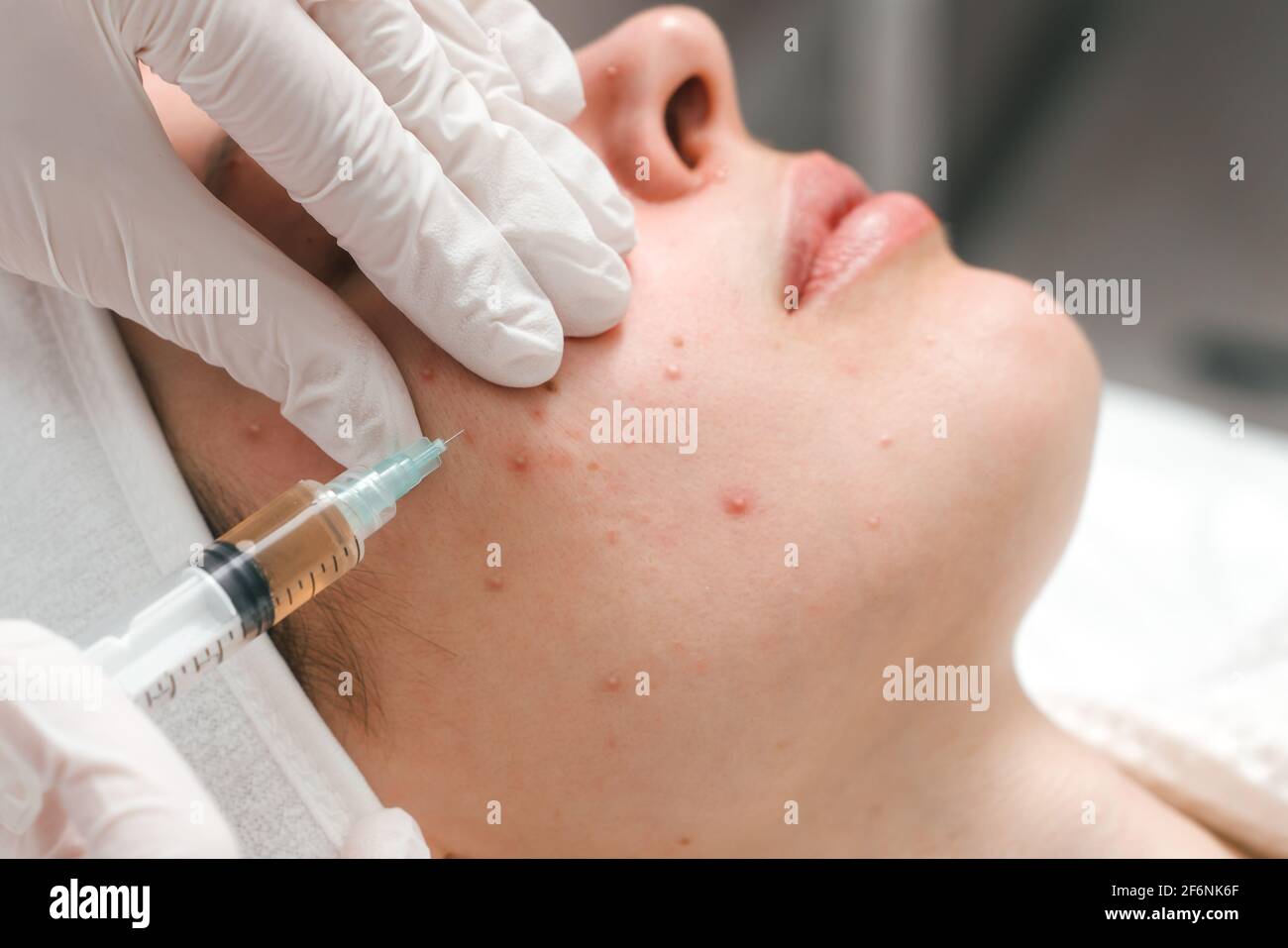 Eine junge Frau in einer Klinik für Kosmetologie, die sich einer  Aknebehandlung mit Injektionen unterzieht. Ein wirksames Mittel gegen Akne  Stockfotografie - Alamy
