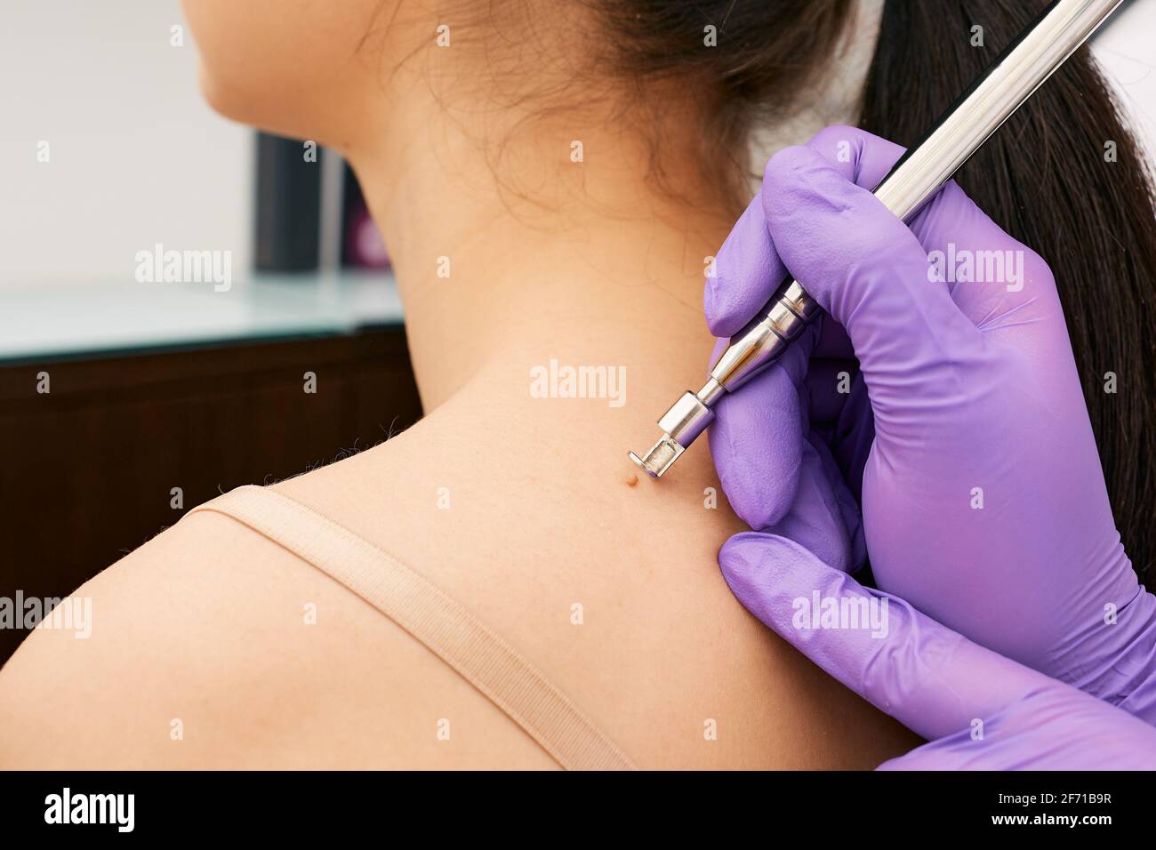 Nahaufnahme eines Dermatologen, der mit einem Lasermesser einen Maulwurf auf dem Rücken einer Frau entfernt. Schmerzlose Entfernung von gutartigen Hautläsionen im medizinischen Zentrum Stockfoto