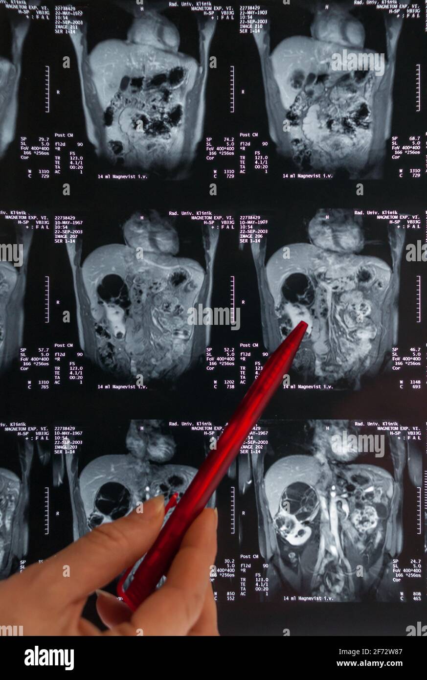 Magnetresonanztomographie, MRT, Computertomographie, Röntgenbild. Bereich des Beckens mit Nieren, die mit Tumoren infiziert sind. ​​the Stockfoto