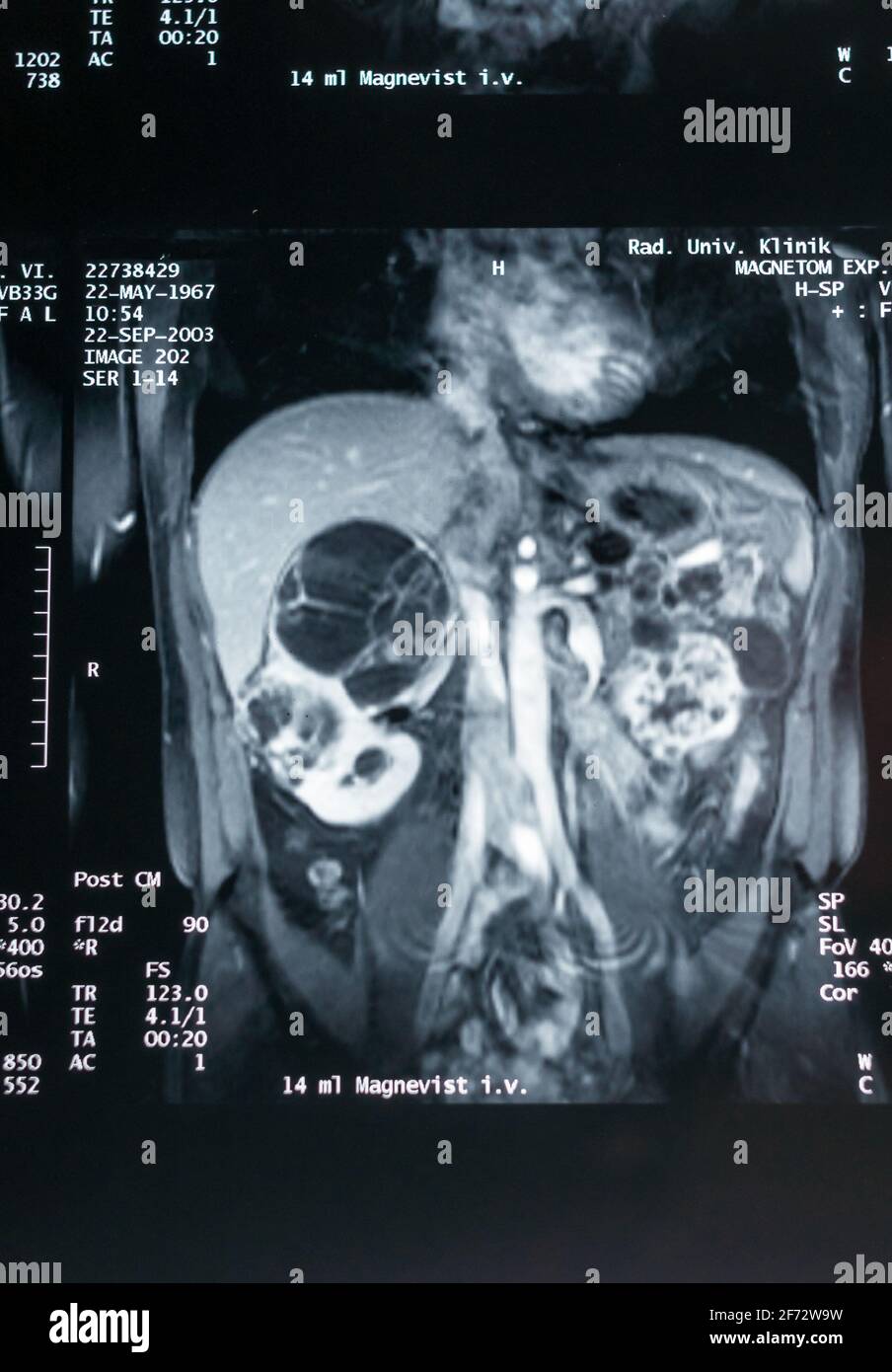 Magnetresonanztomographie, MRT, Computertomographie, Röntgenbild. Bereich des Beckens mit Nieren, die mit Tumoren infiziert sind. ​​the Stockfoto