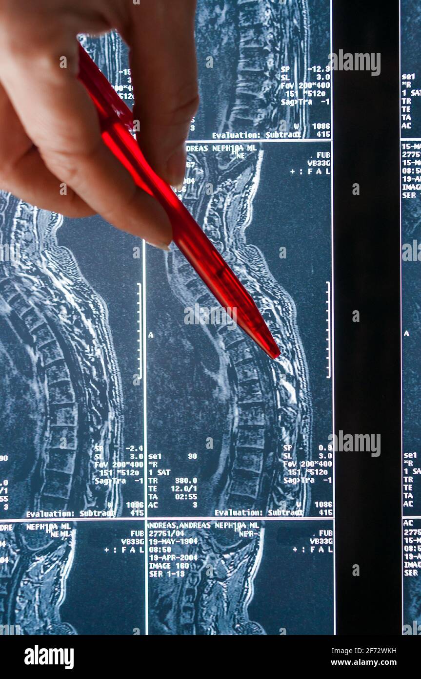 Magnetresonanztomographie, MRT, Computertomographie, Röntgenbild. Querschnitt der Wirbelsäule Stockfoto