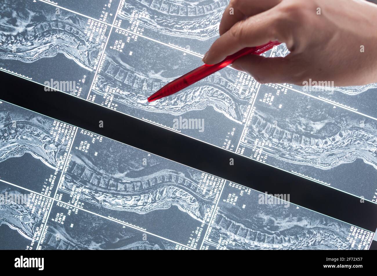 Magnetresonanztomographie, MRT, Computertomographie, Röntgenbild. Querschnitt der Wirbelsäule Stockfoto