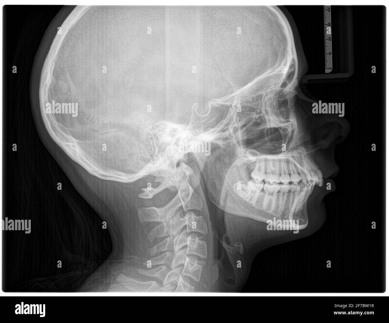 Röntgenaufnahme der Schädelknochen in lateraler Projektion mit oberem Wirbelsäulenwirbel Stockfoto