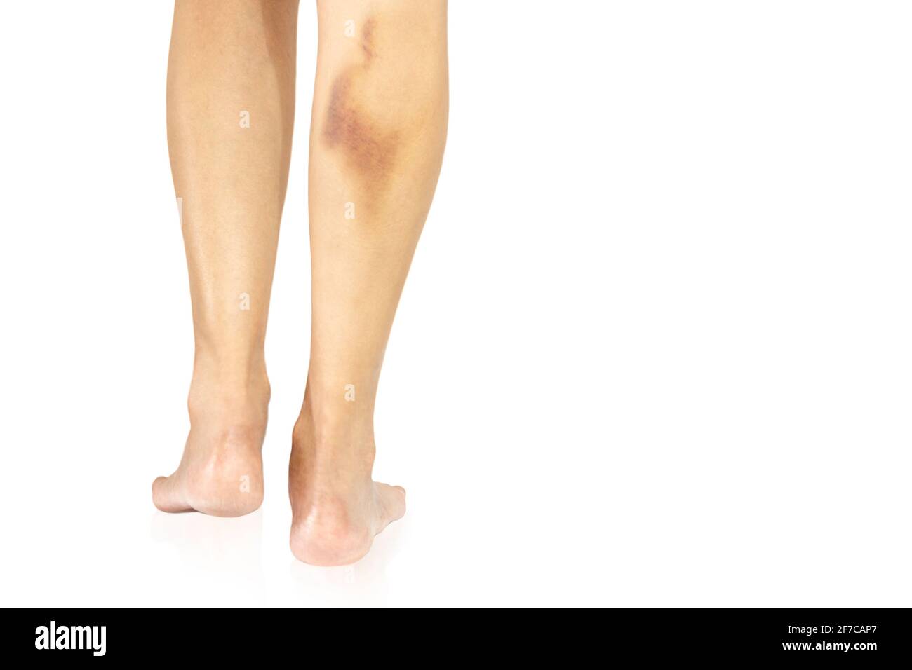 Große Blutergüsse auf dem weiblichen Bein isoliert in Schneideweg. Stockfoto
