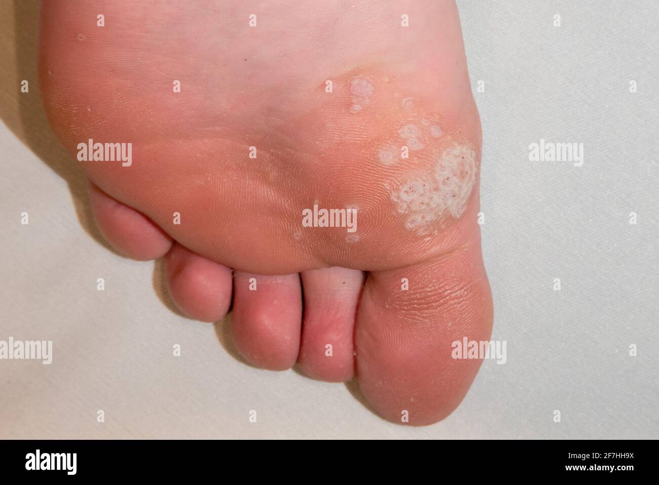 Fußsohle mit Mosaikplantar Warze und anderen Verrucas Einschließlich der schwarzen Fleck gerinnt Blutgefäßzentren Stockfoto