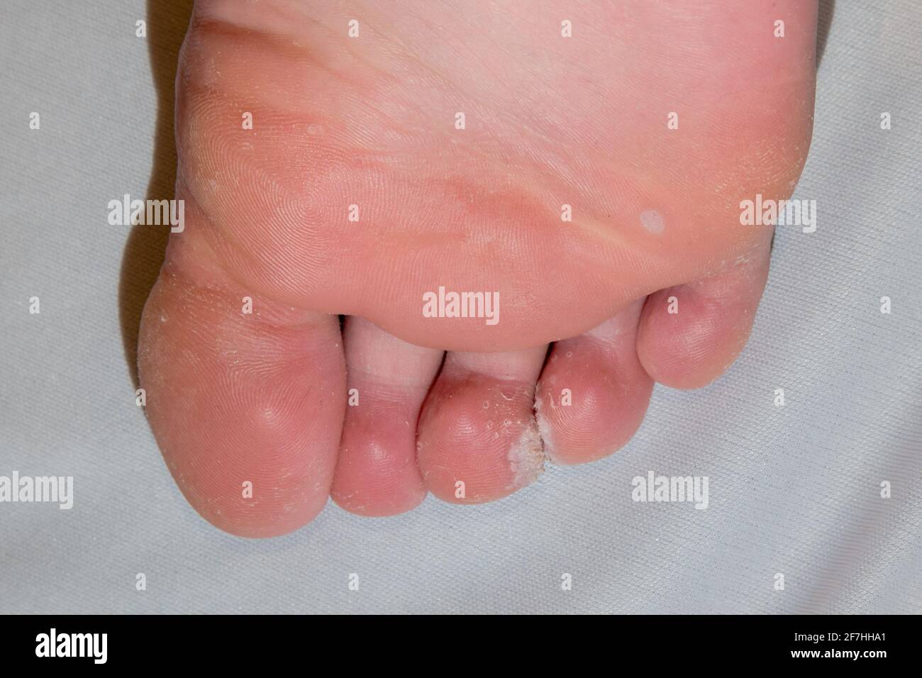 Fußsohle mit Mosaikplantar Warze Verrucas zwischen den Zehen Mit trockener, rauer Haut Stockfoto