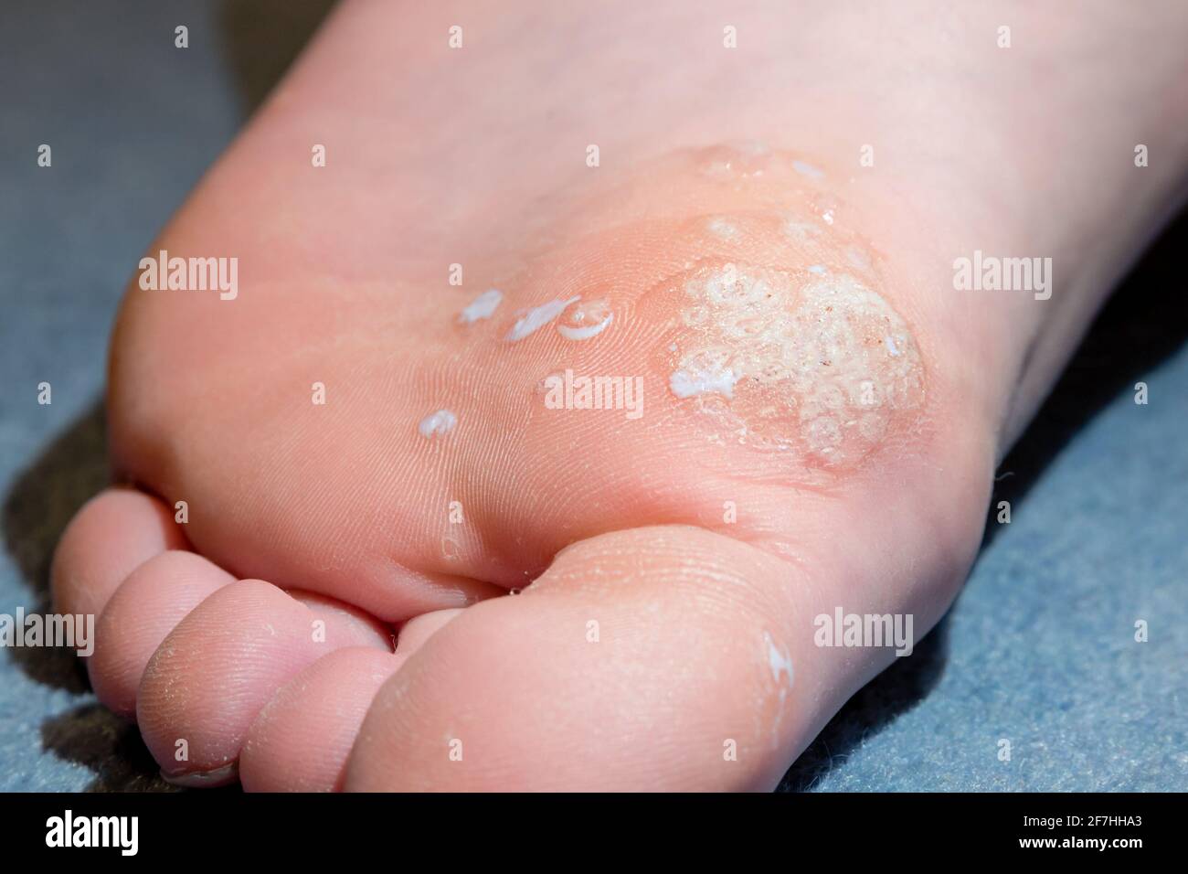 Fußsohle mit Salicylsäure-Behandlung von Mosaikplantar Warze und andere Verrucas Stockfoto