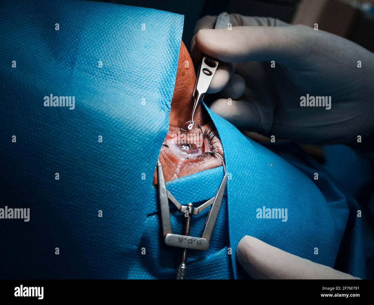 basra, Irak - 8. april 2021: Chirurg setzt Kontaktlets auf die Hornhaut nach PRK-Operation Stockfoto