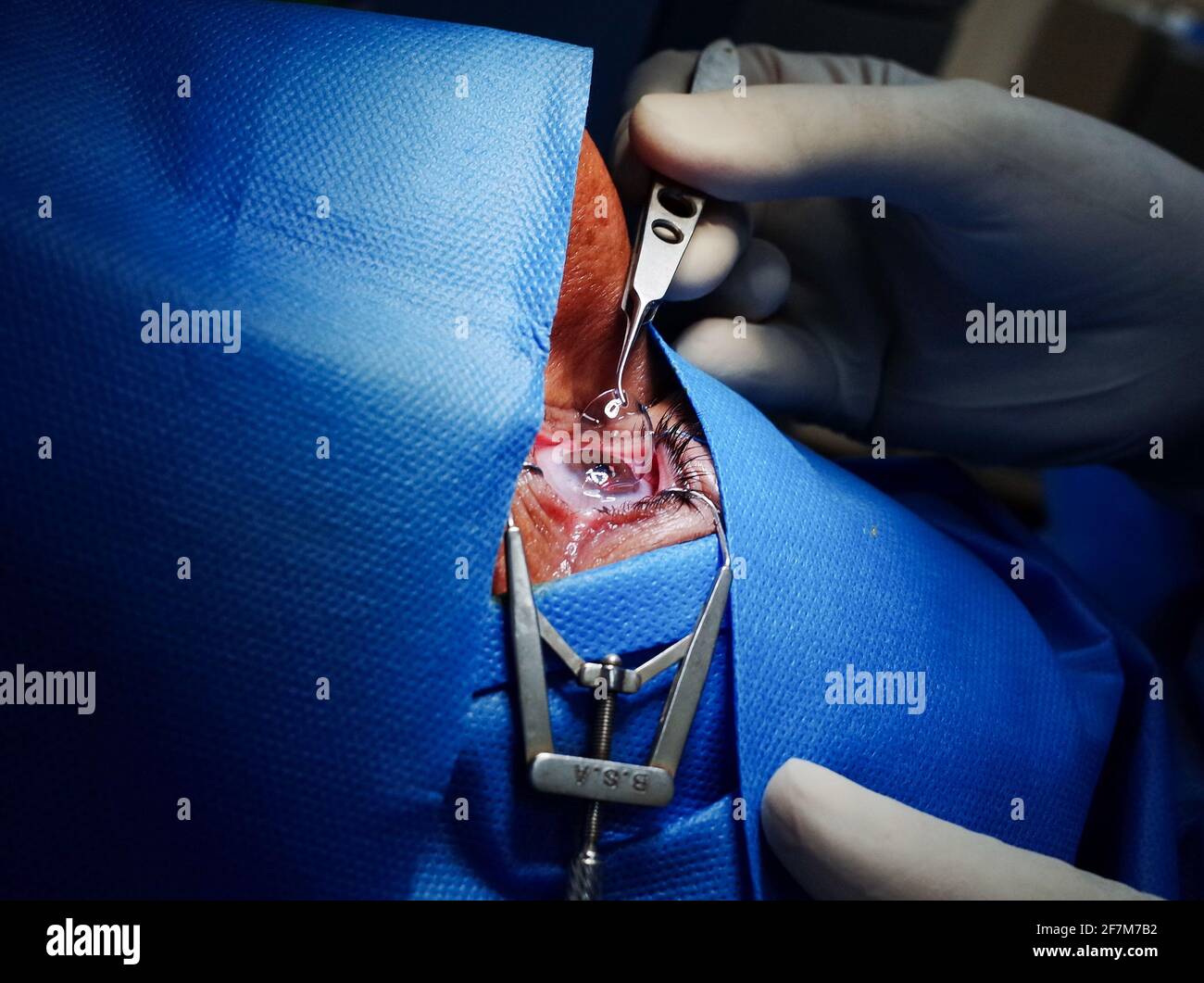 basra, Irak - 8. april 2021: Chirurg setzt Kontaktlets auf die Hornhaut nach PRK-Operation Stockfoto