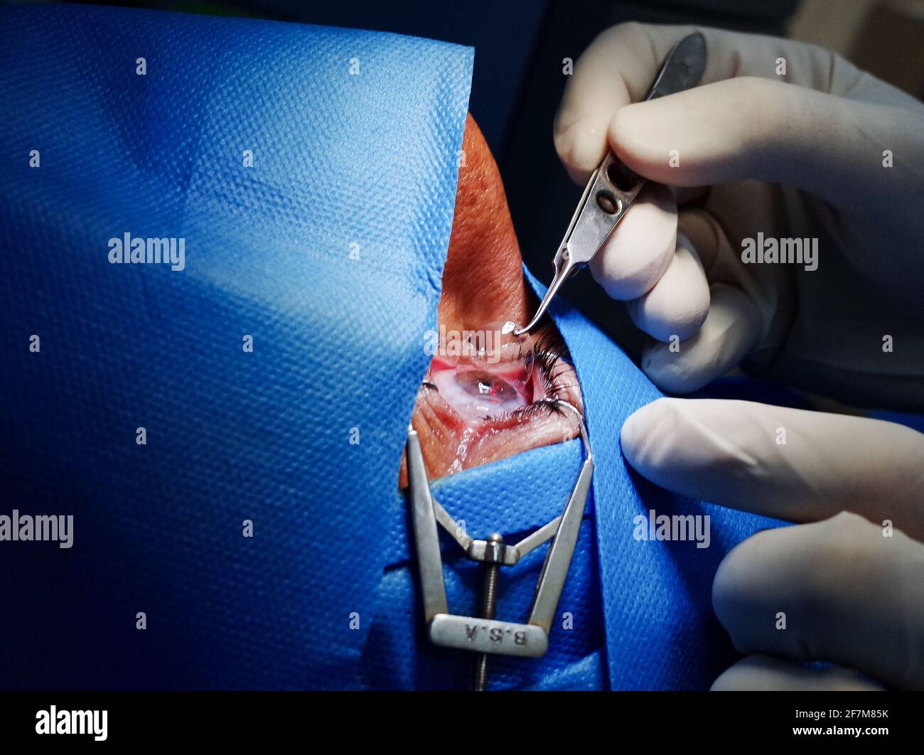 basra, Irak - 8. april 2021: Chirurg setzt Kontaktlets auf die Hornhaut nach PRK-Operation Stockfoto