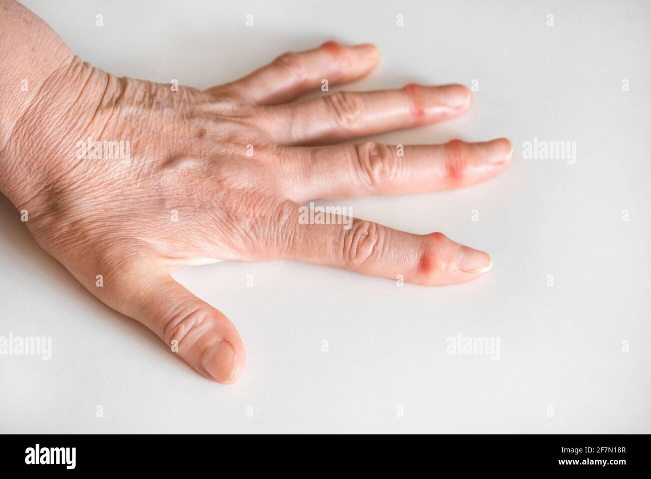 Kranke weibliche Finger einer älteren Hand auf weißem Hintergrund. Stockfoto