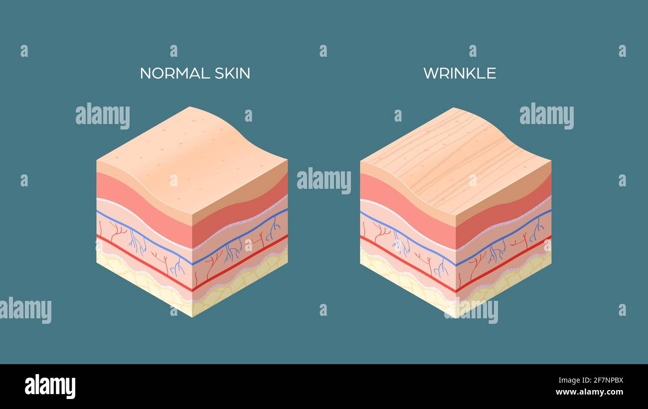 Falten und normaler Hautquerschnitt der menschlichen Hautschichten Struktur Hautpflege medizinisches Konzept flach horizontal Stock Vektor