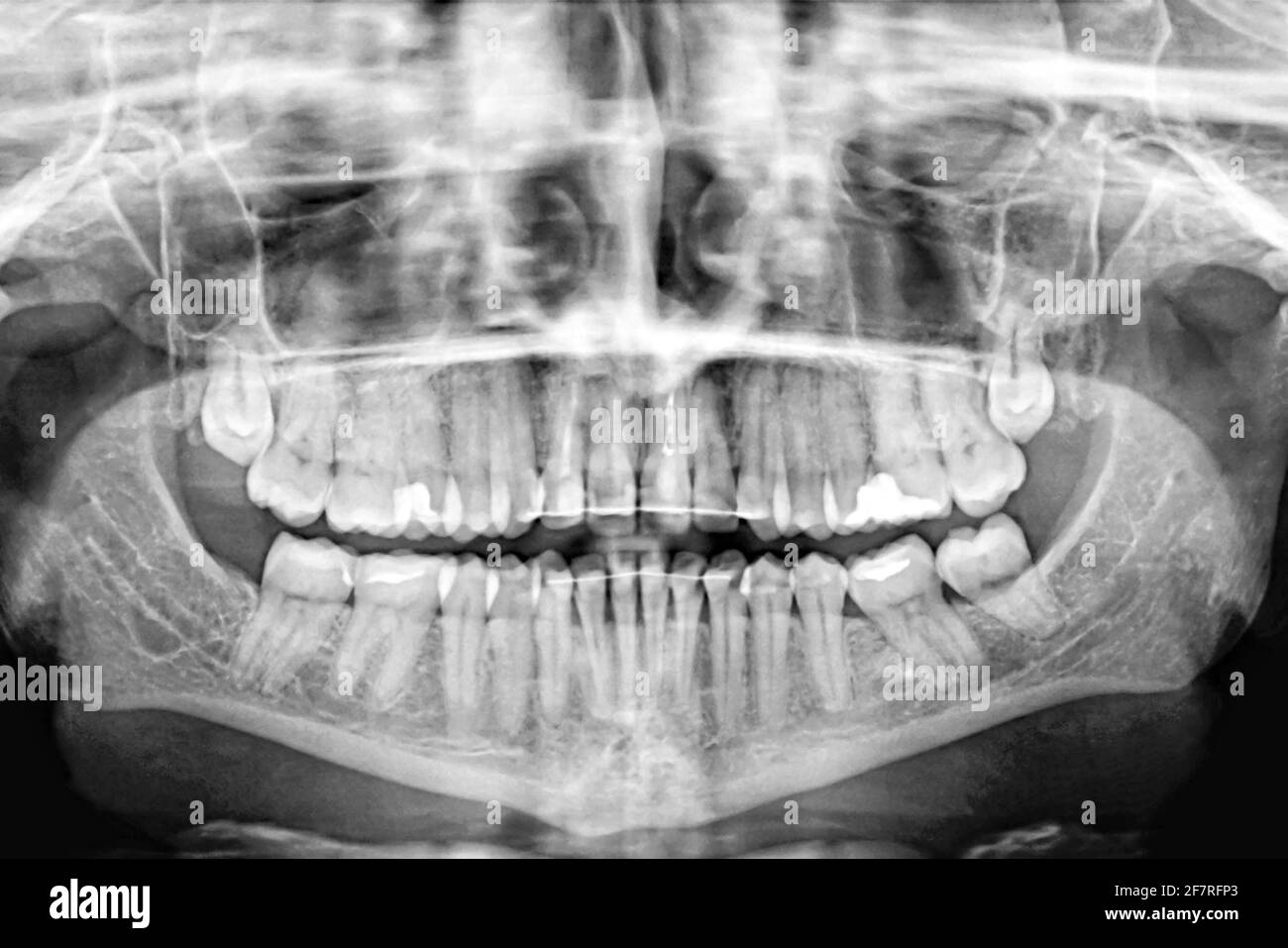 Panorama-Röntgenaufnahme von menschlichen Zähnen.Untersuchung und Behandlung. Zahnpflege.Banner. Stockfoto
