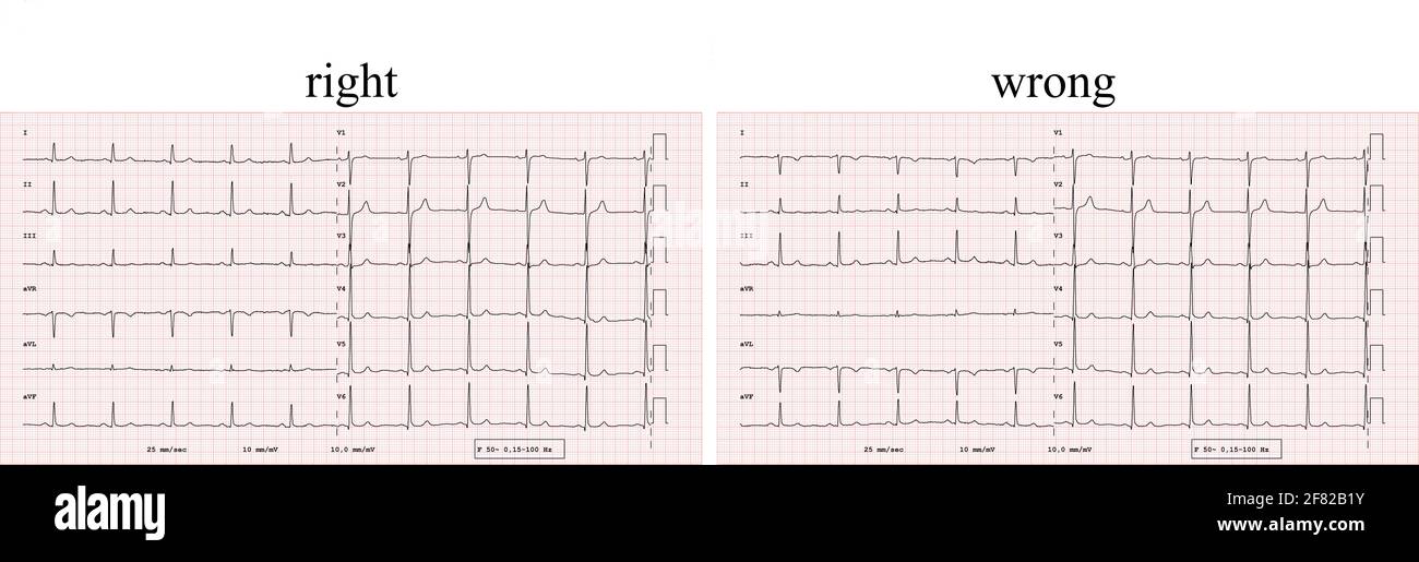 EKG-Beispiel für einen normalen 12-Kanal-Sinusrhythmus, Vergleich der korrekten und falschen Positionierung der Elektrode Stockfoto