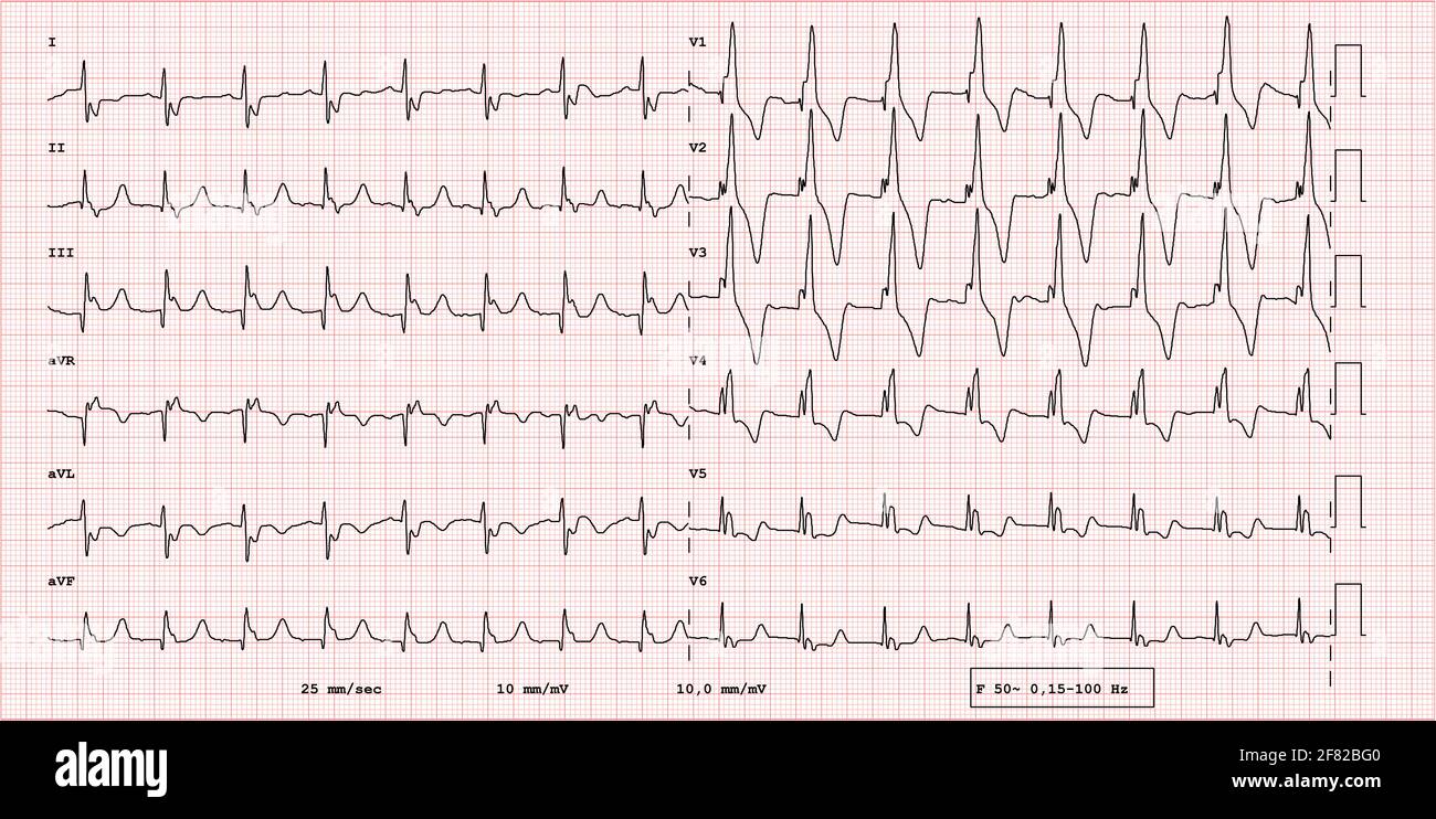 EKG-Beispiel für einen pathologischen 12-Kanal-Rhythmus, Fallots Tetralogie Stockfoto