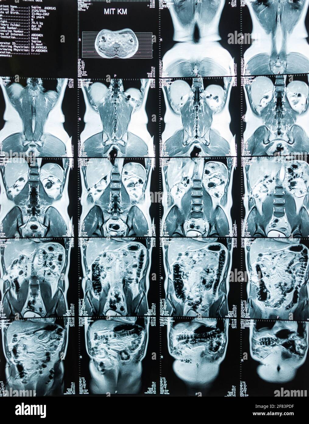 Magnetresonanztomographie, MRT, Computertomographie, Röntgenbild. Bauchbereich im Querschnittsbereich des ​​the Beckens mit Nieren, die mit tum infiziert sind Stockfoto
