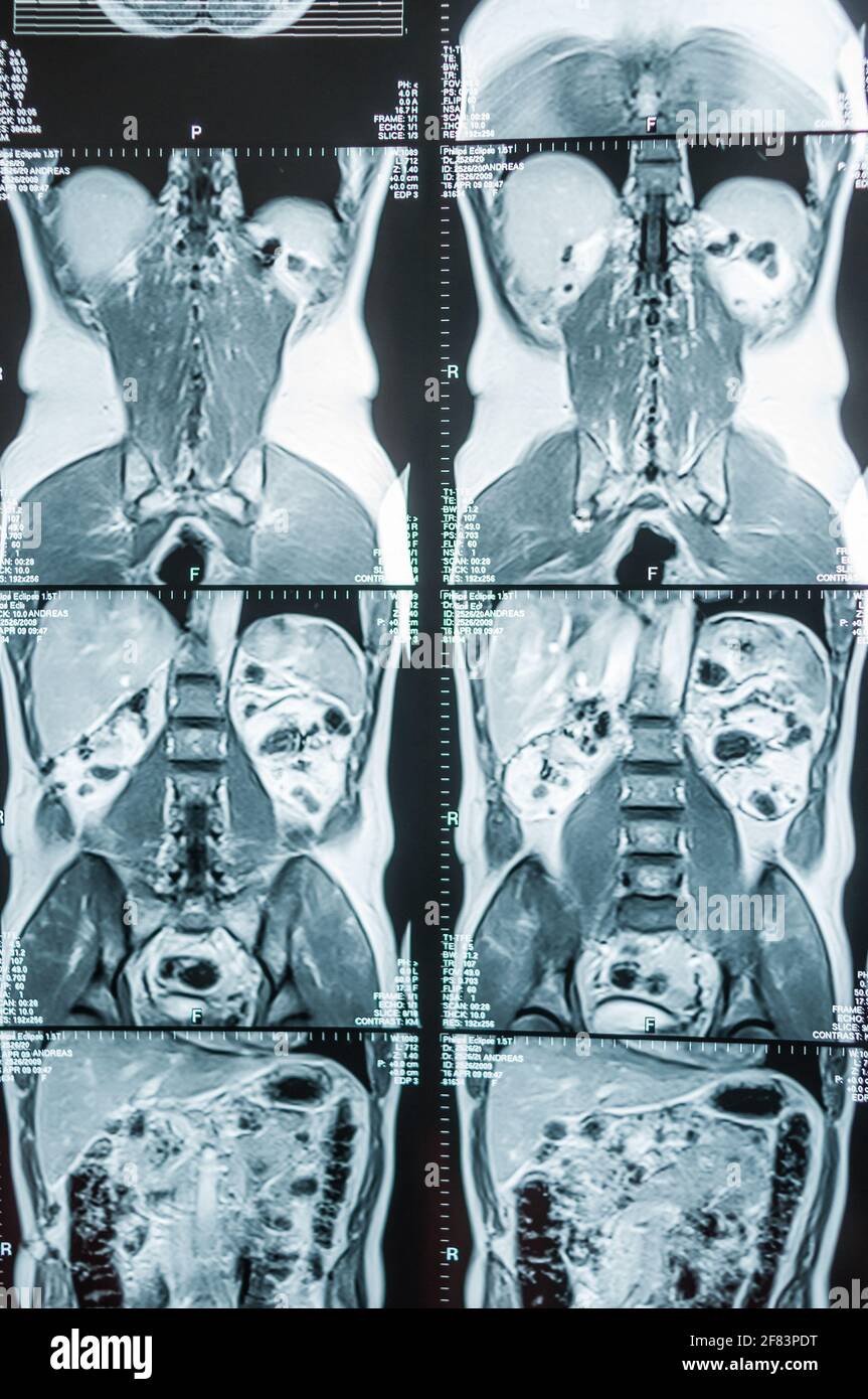 Magnetresonanztomographie, MRT, Computertomographie, Röntgenbild. Bauchbereich im Querschnittsbereich des ​​the Beckens mit Nieren, die mit tum infiziert sind Stockfoto