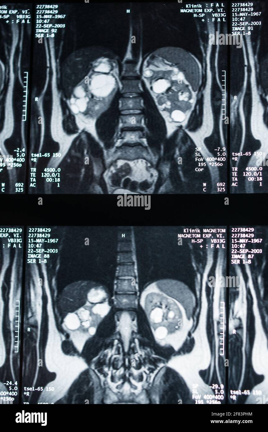 Magnetresonanztomographie, MRT, Computertomographie, Röntgenbild. Bereich des Beckens mit Nieren, die mit Tumoren infiziert sind. ​​the Stockfoto