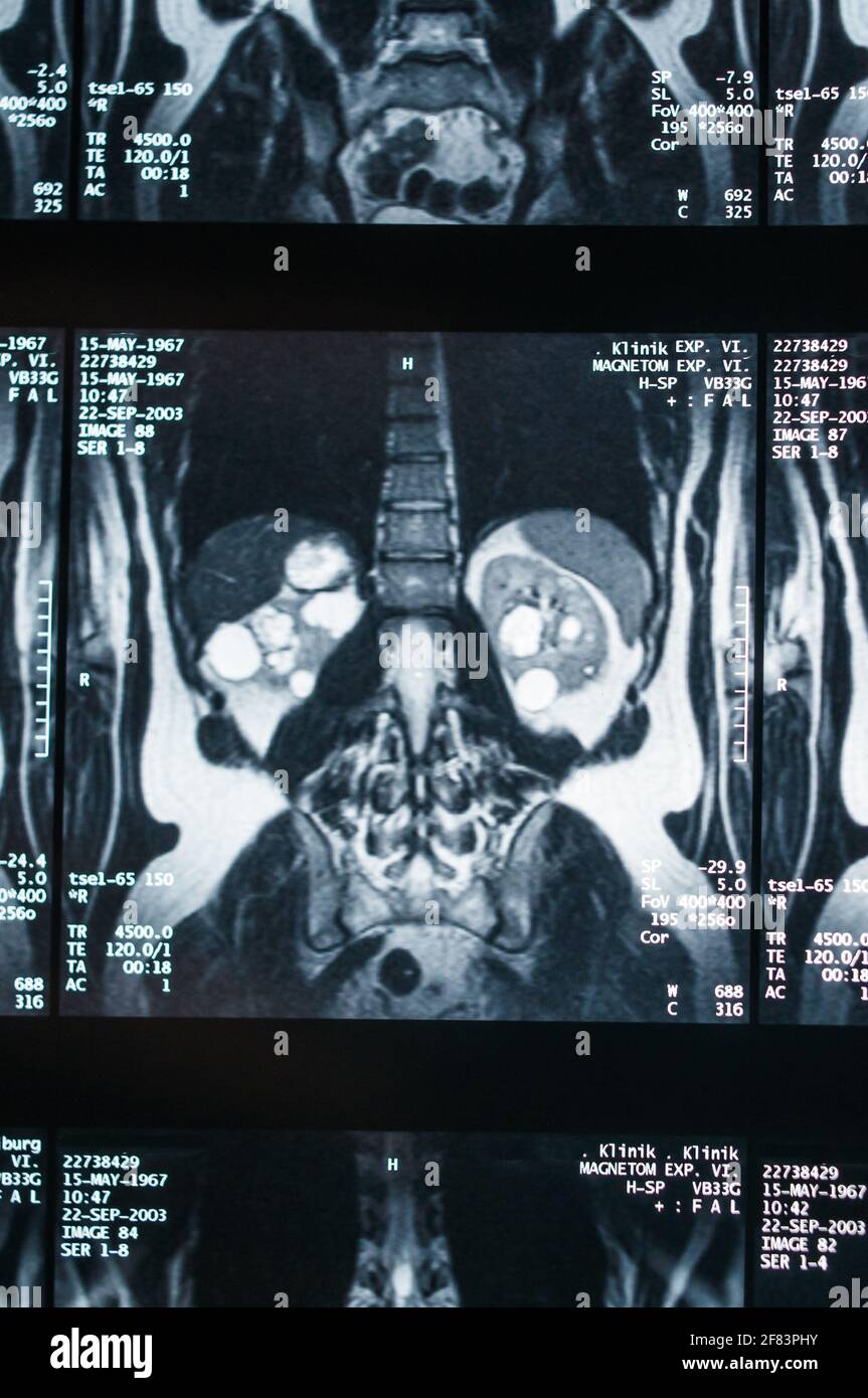 Magnetresonanztomographie, MRT, Computertomographie, Röntgenbild. Bereich des Beckens mit Nieren, die mit Tumoren infiziert sind. ​​the Stockfoto